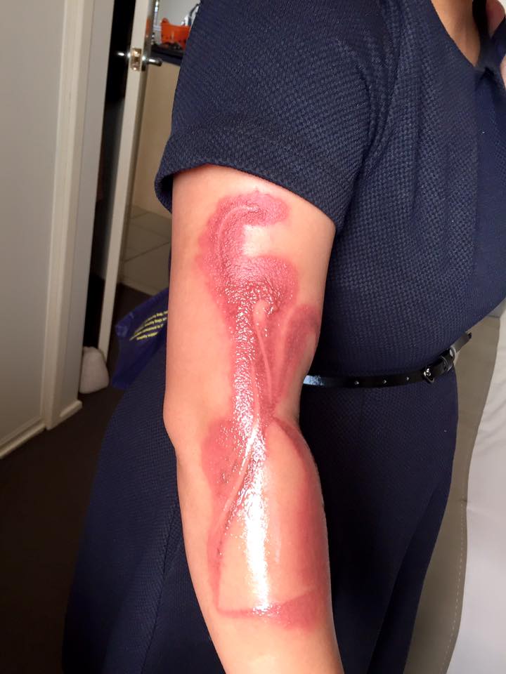 Melanie Tan Pelaez hevder en iPhone 7 skjoldet huden hennes mens den ladet.